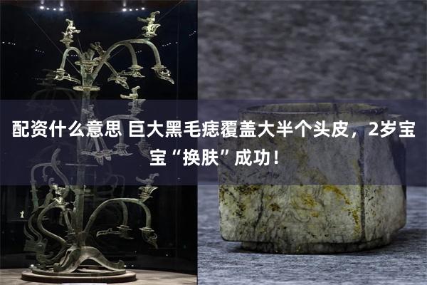 配资什么意思 巨大黑毛痣覆盖大半个头皮，2岁宝宝“换肤”成功！